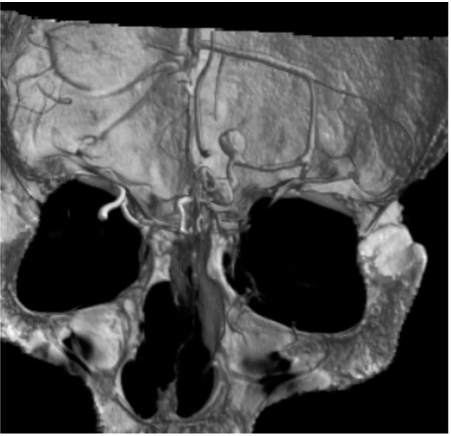 Supraorbital Craniotomy Via A Superior Orbital Supracilliary Eyebrow