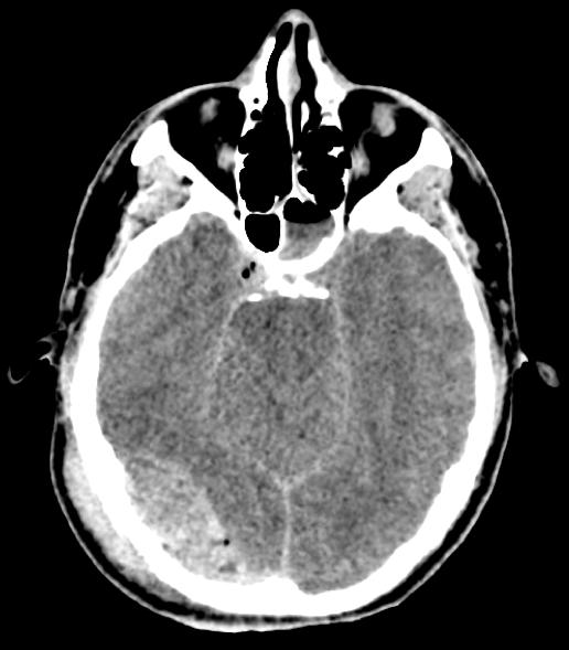 Occipital Craniotomy For Evacuation Of Epidural Hematoma Cns Org