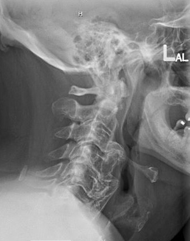 Anterior Cervical Osteophytectomy For Treatment Of Dysphagia Cns Org