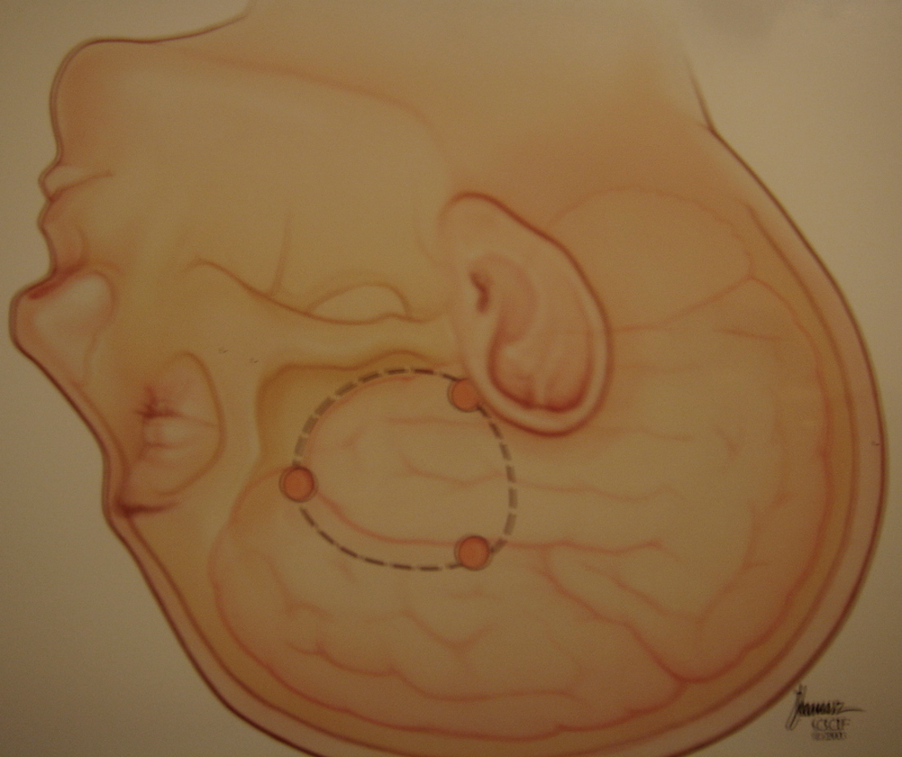 Right Standard Anterior Temporal Lobectomy For Mesial Temporal