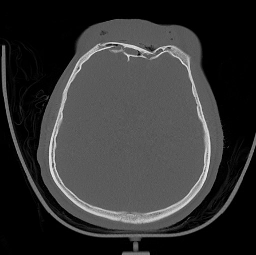 Frontal Sinus Fracture Bifrontal Craniotomy Cns Org