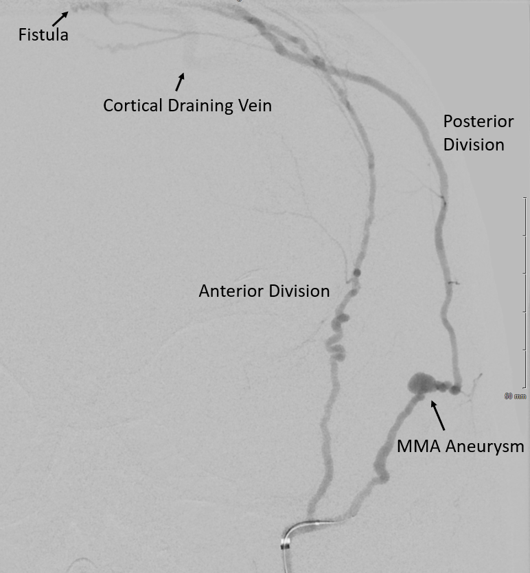 Ruptured Dural Arteriovenous Fistula And Flow Related Aneurysm Of The