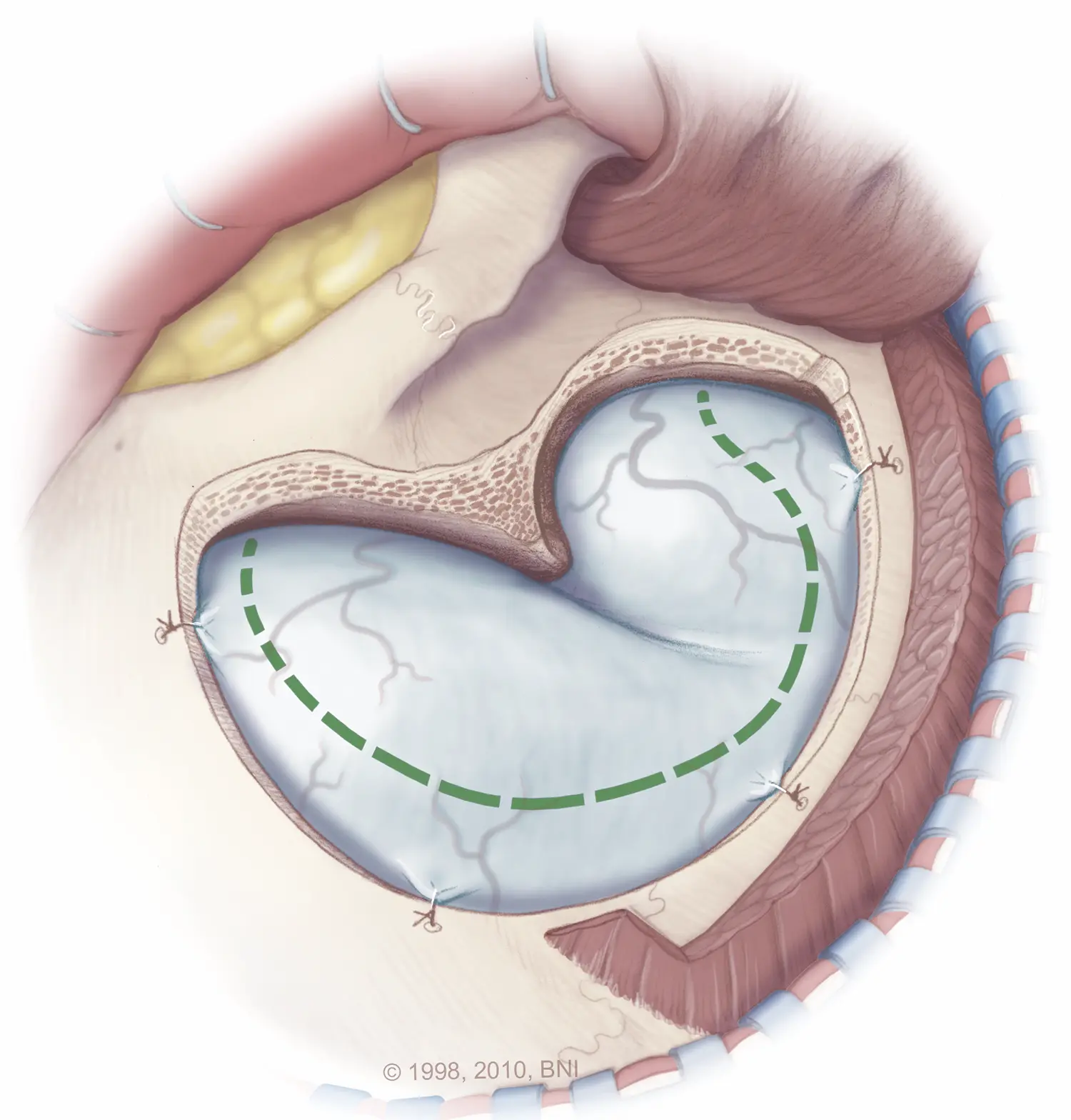 Right Pterional Craniotomy For Olfactory Groove Meningioma Cns Org