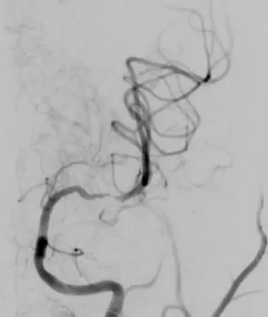 Intracranial Angioplasty And Stenting For Symptomatic Intracranial