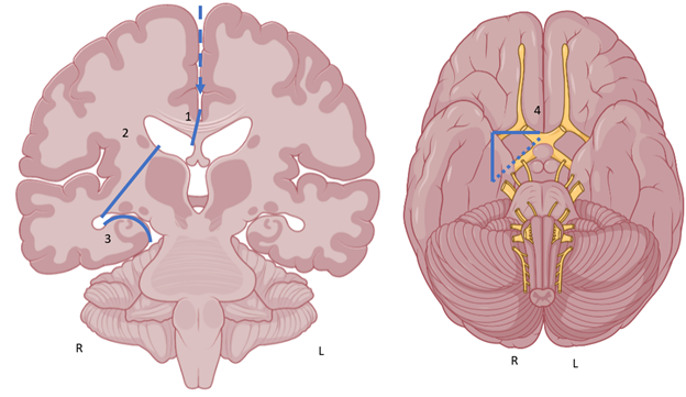 Endoscope Assisted Vertical Hemispherectomy