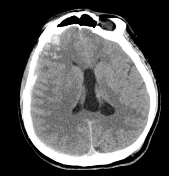Massive Cerebral Contusion Expansion Requiring Hemicraniectomy - cns.org