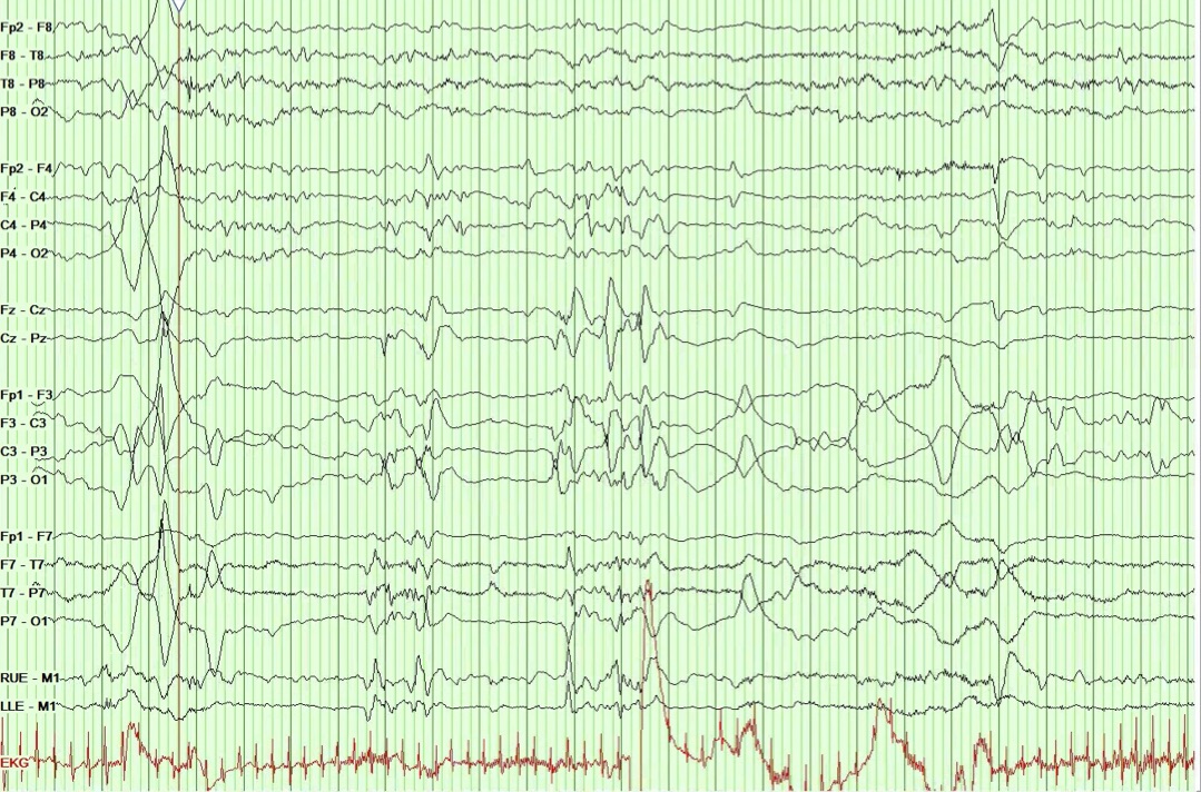 P3 Infant, Case of 9