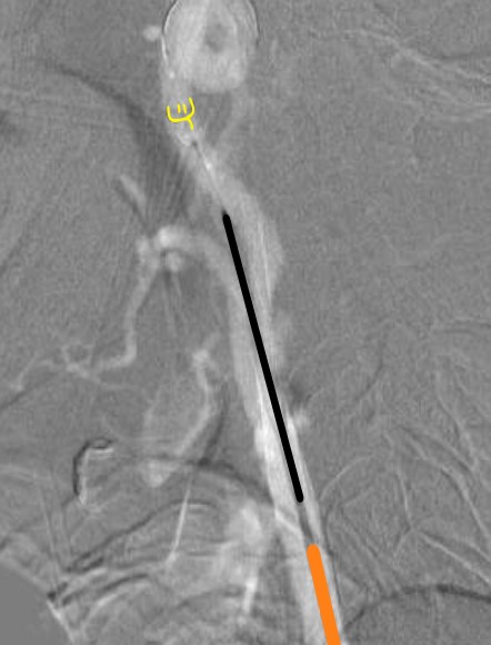 Carotid Artery Stenting and Angioplasty for Symptomatic Carotid Artery Stenting and Angioplasty for Symptomatic