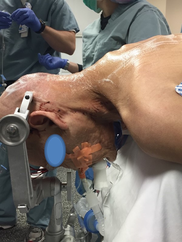 Arthrex - FiberTak® SpeedBridge™ Rotator Cuff Repair