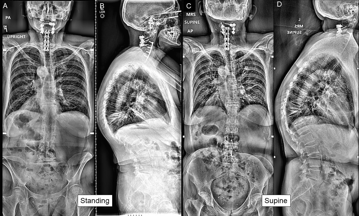 【here's】SPINAL DOUBLE PIERCE here's】SPINAL DOUBLE PIERCE here's】SPINAL DOUBLE PIERCE here's