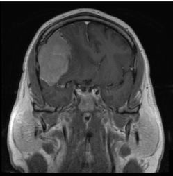 Frontotemporal craniotomy for resection of meningioma - cns.org