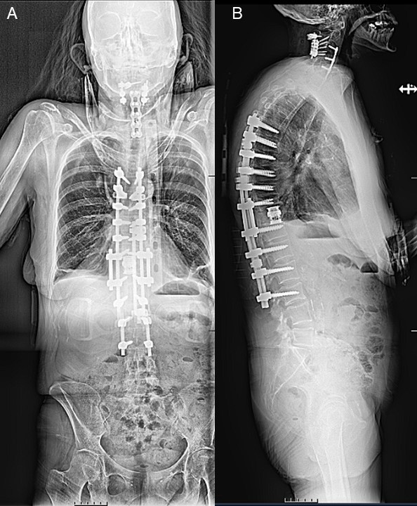 T11 Vertebral Column Resection Complicated by Postoperative