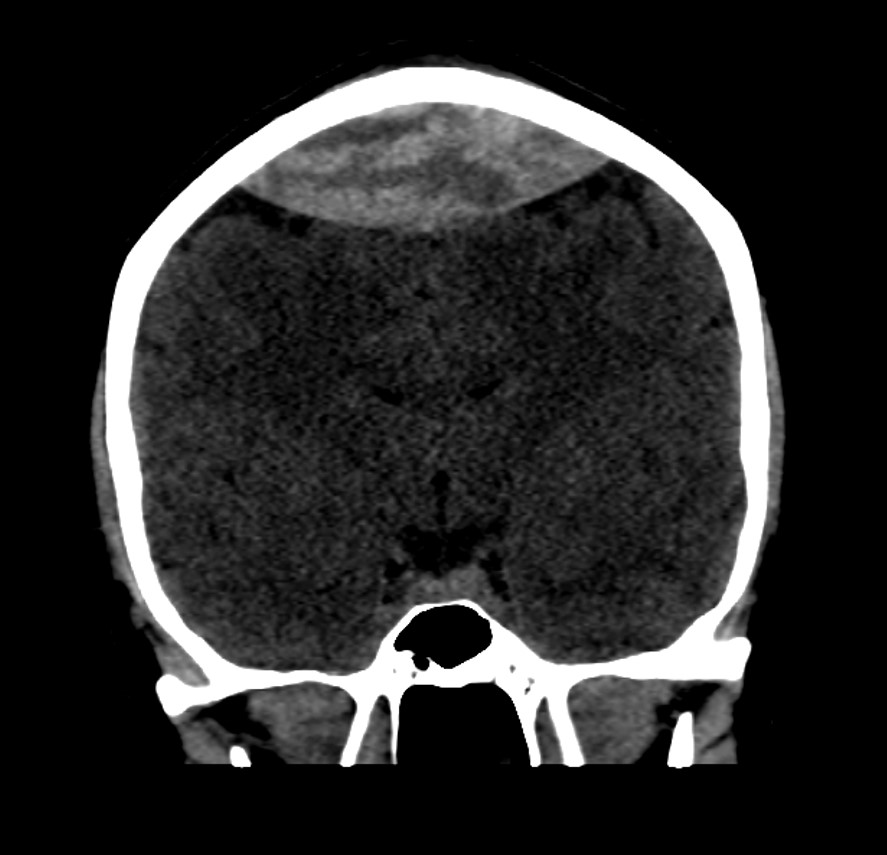 Bilateral Craniotomy For Superior Sagittal Sinus Related Epidural Hematoma 5235