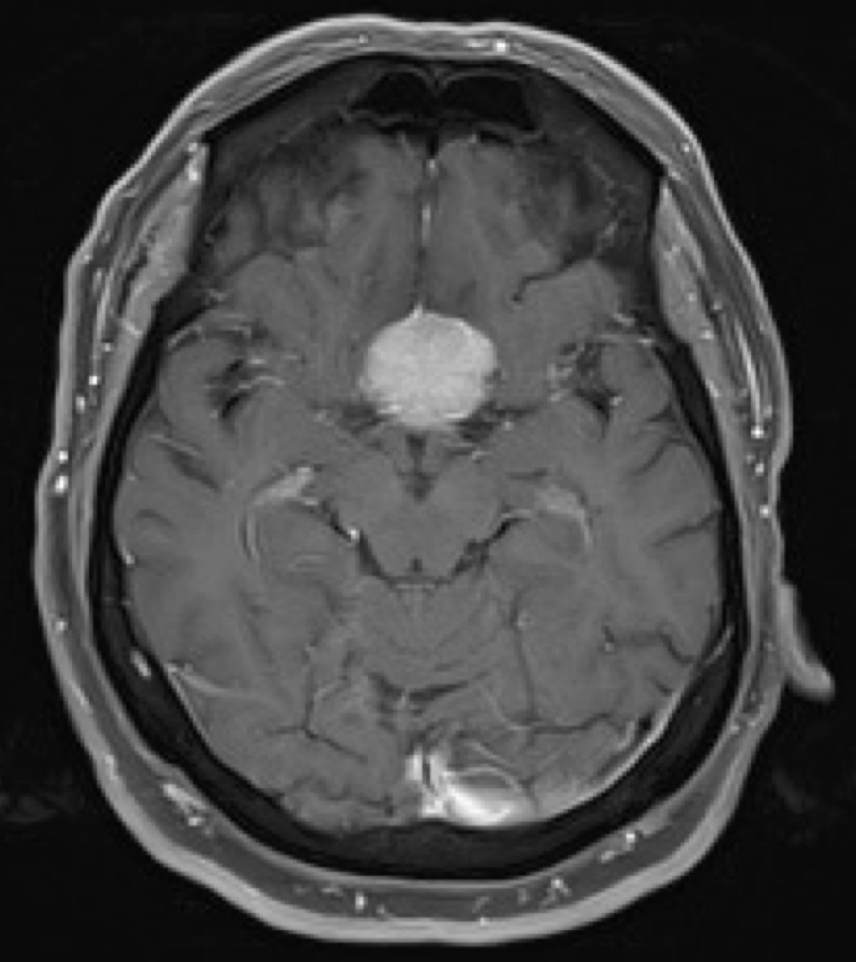 Tuberculum Sellae Meningioma