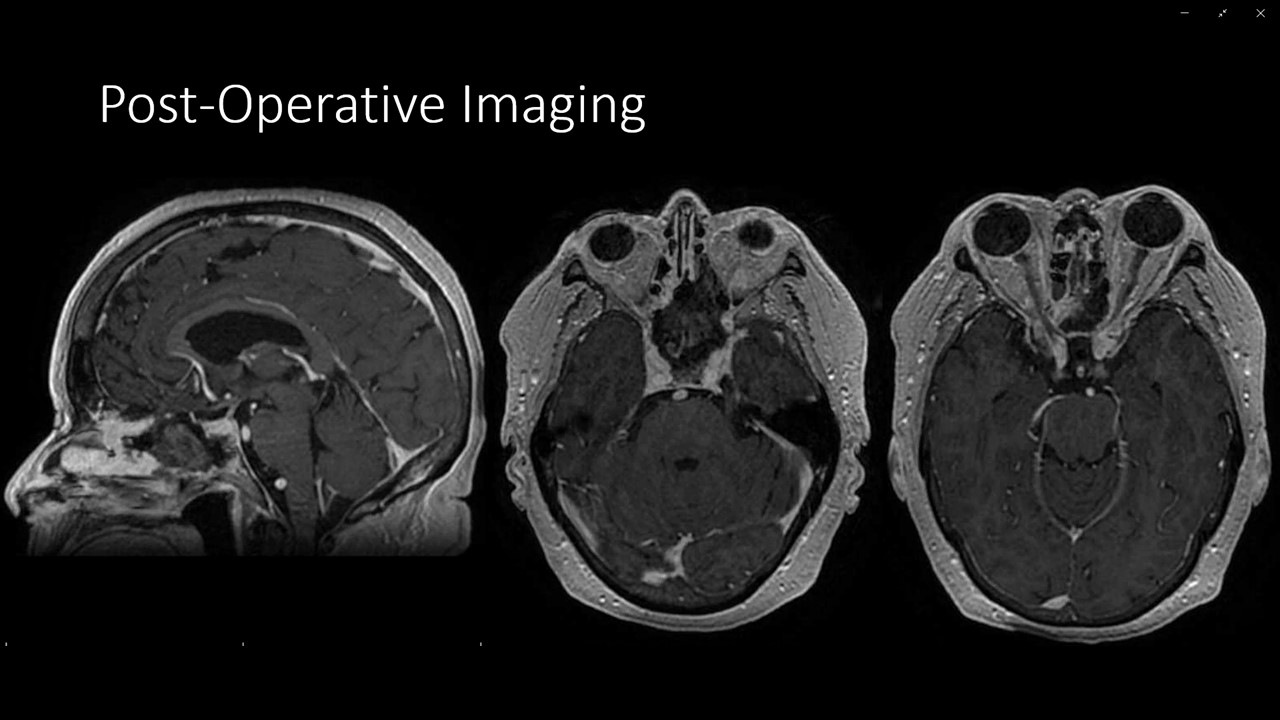 Endoscopic Transnasal Resection of Large Clival Chordoma - cns.org