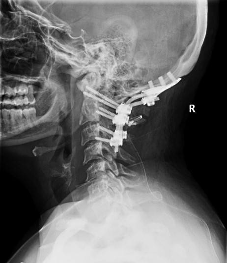 Occipito-Cervical Fusion for Tumor Destruction of Occipital Condyle ...