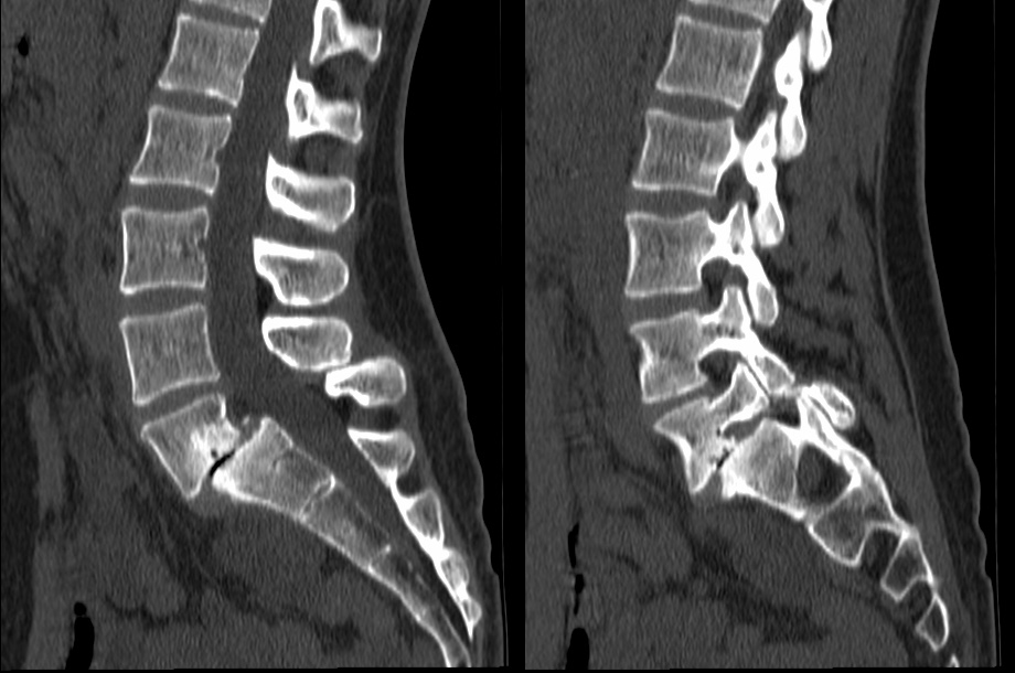 Anterior lumbar interbody fusion for grade 2 spondylolisthesis 