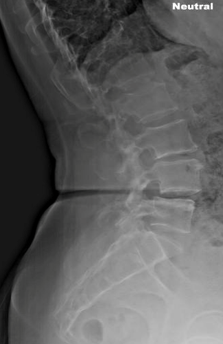 Posterolateral interbody fusion with correction of spondylolisthesis ...