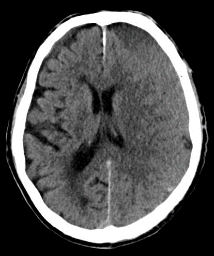 Nonoperative Management of Chronic Subdural Hematoma - cns.org