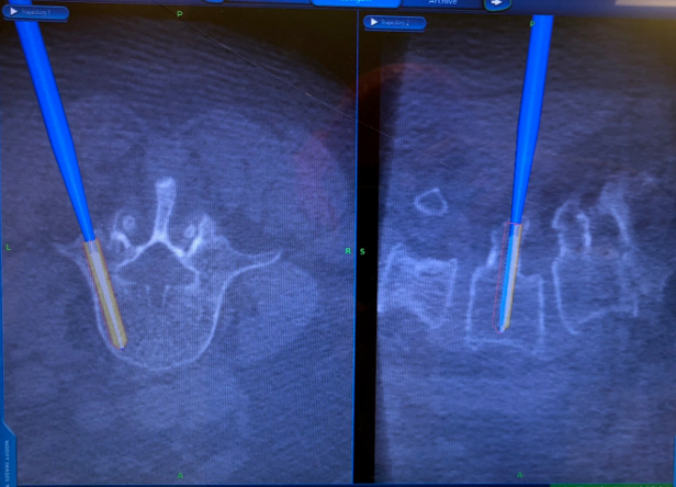 mis-lumbar-laminectomy-and-percutaneous-instrumentation-for-epidural