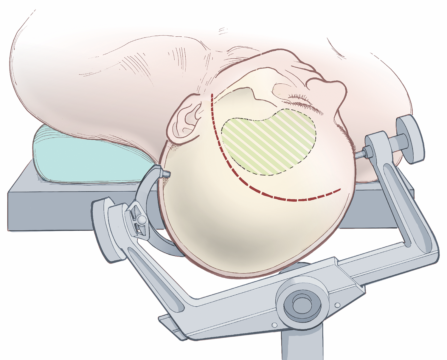 left-pterional-craniotomy-for-mca-and-acom-aneurysms-cns