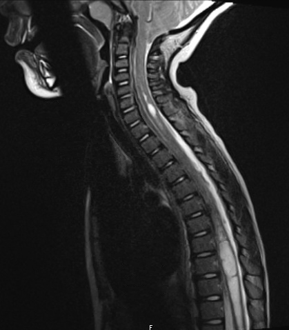 Suboccipital Craniectomy and C1 laminectomy for chiari decompression ...