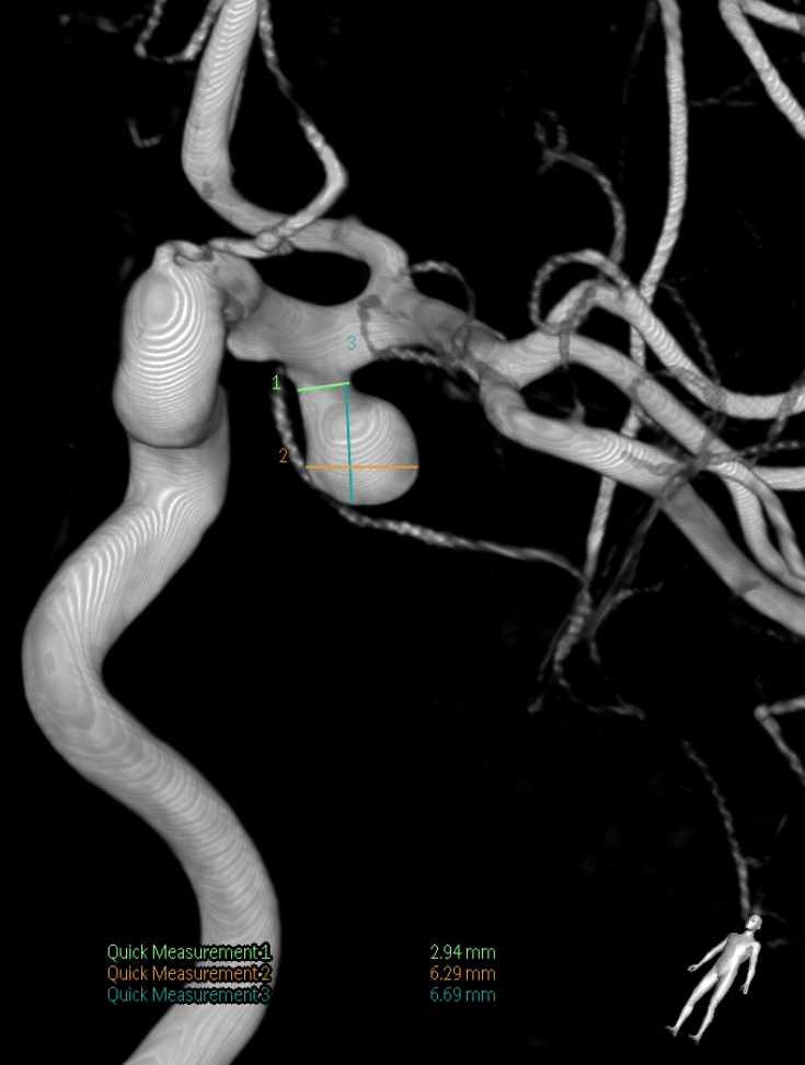 Left Pterional Craniotomy For Ica Aneurysm