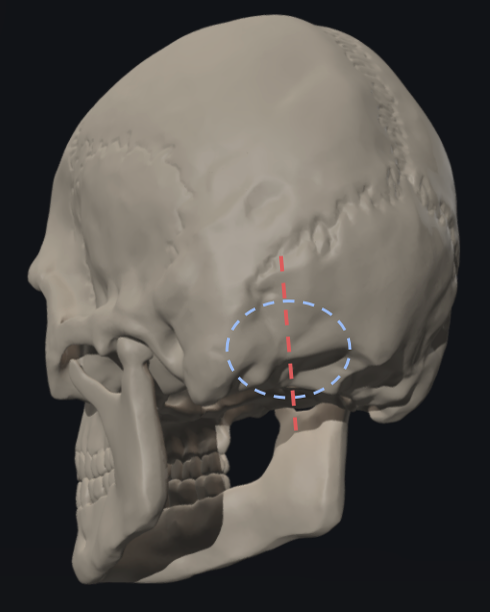 Left retrosigmoid suboccipital craniectomy for resection of epidermoid ...