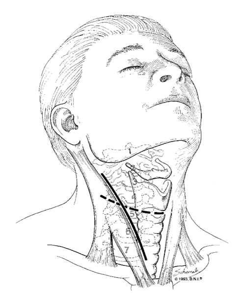 C6 Corpectomy for Cervical Spondylotic Myelopathy - cns.org