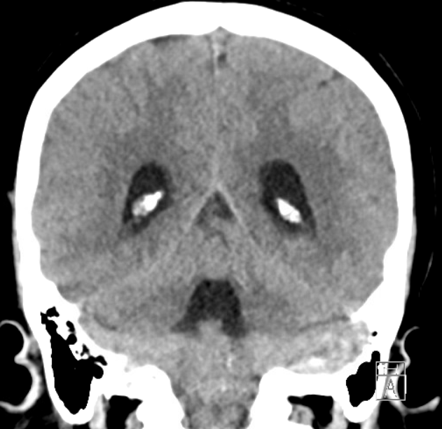 Microsurgical removal of a Fourth Ventricle Ependymoma with