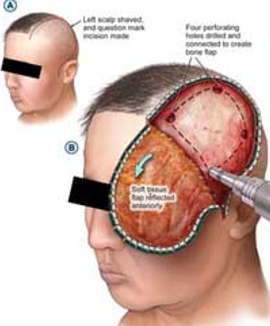 Acute Subdural Hematoma Craniotomy Evacuation