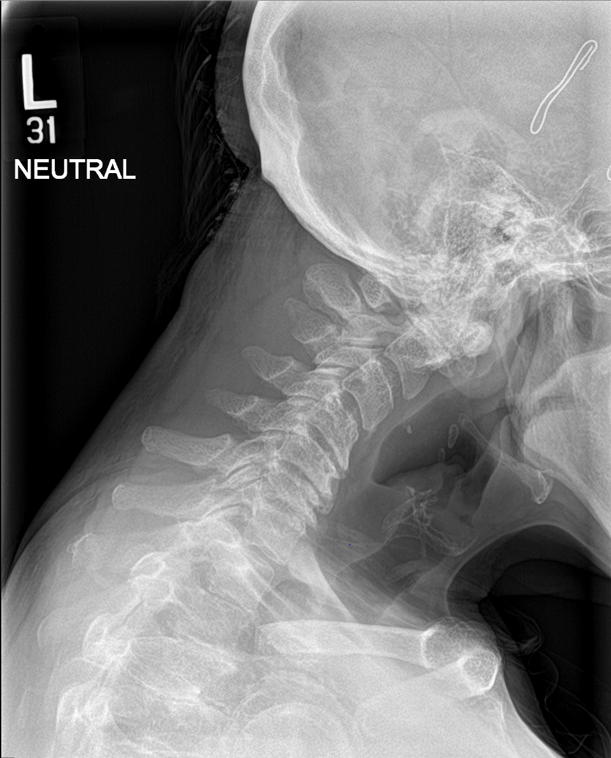 Spinal Cervical Deformity - Neurosurgery