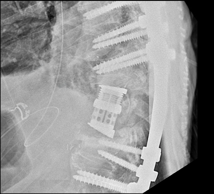 Severe Kyphotic Deformity Corrected by Three-Level Vertebral