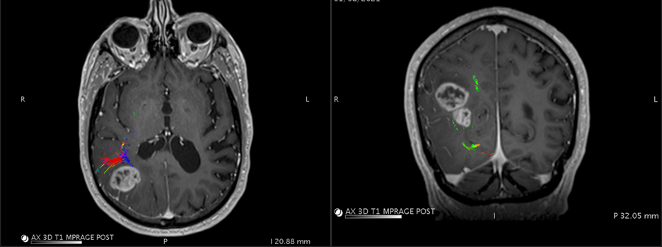 Right parietal craniotomy for resection of multilobular high-grade ...