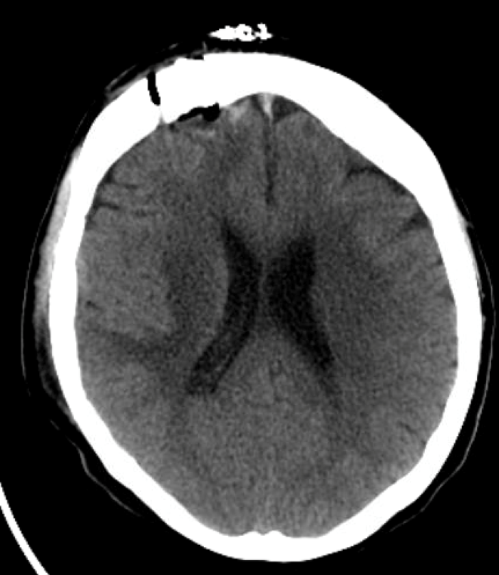 Right frontal craniotomy for brain biopsy - cns.org