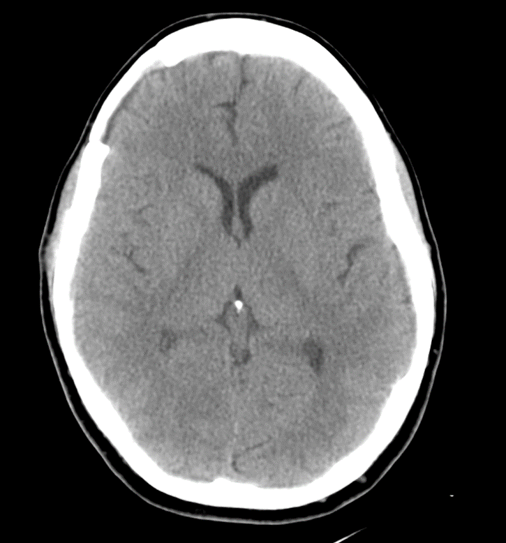 Right Pterional Craniotomy for Penetrating Head Injury - cns.org