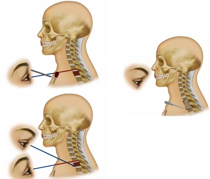 Anterior Approach To Cervicothoracic Junction - Cns.org