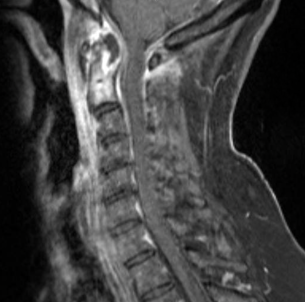 Transoral Approach for Evacuation of Retro-Odontoid Abscess 