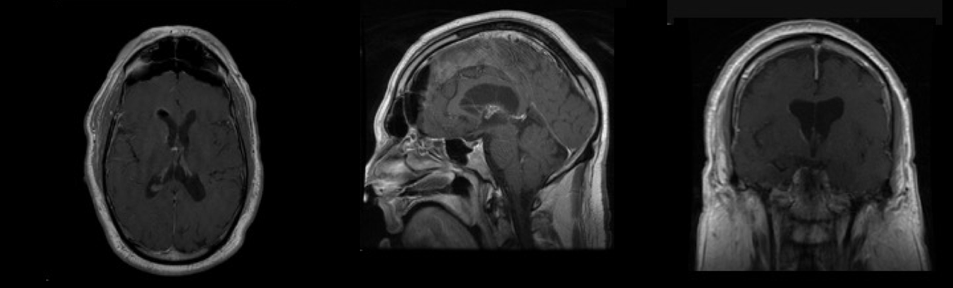 Transcortical Endoport for Colloid Cyst - cns.org