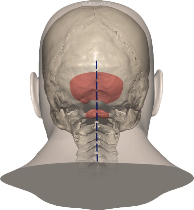 Suboccipital craniotomy with C1 laminectomy for resection of 4th ...