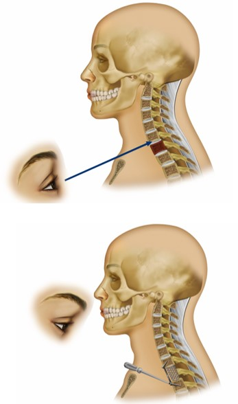 Anterior approach to cervicothoracic junction - cns.org