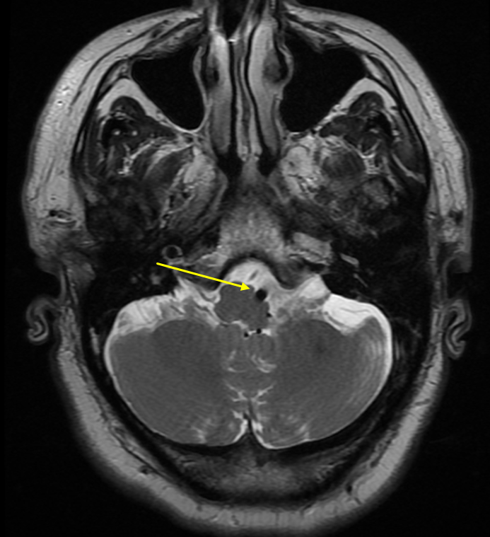 Left retrosigmoid craniotomy for microvascular decompression of ...