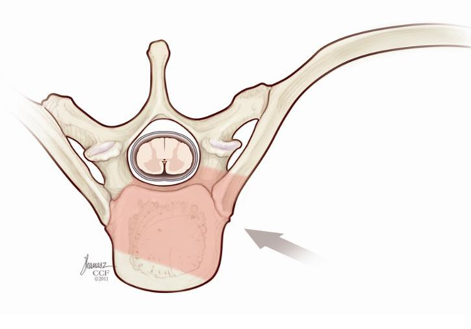 Posterior thoracic corpectomy for tumor with expandable cage - cns.org