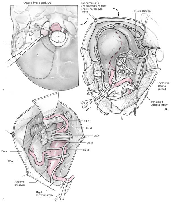 Far Lateral Approach For A Pica Aneurysm 7089