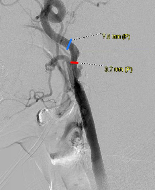 Carotid Artery Stenting and Angioplasty for Symptomatic Carotid 