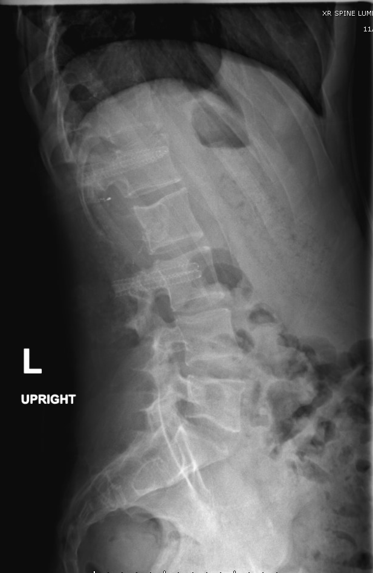 Resection of a Locally-Aggressive Lumbar Aneurysmal Bone Cyst - cns.org