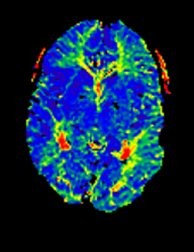 Left Encephalodurosynangiosis for Moyamoya - cns.org