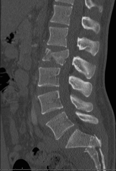 Thoracolumbar-pelvic Fixation for Concomitant Sacral and Lumbar ...