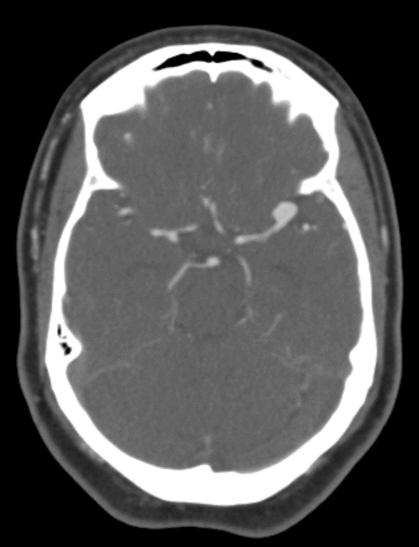 Pterional craniotomy for left MCA aneurysm clipping