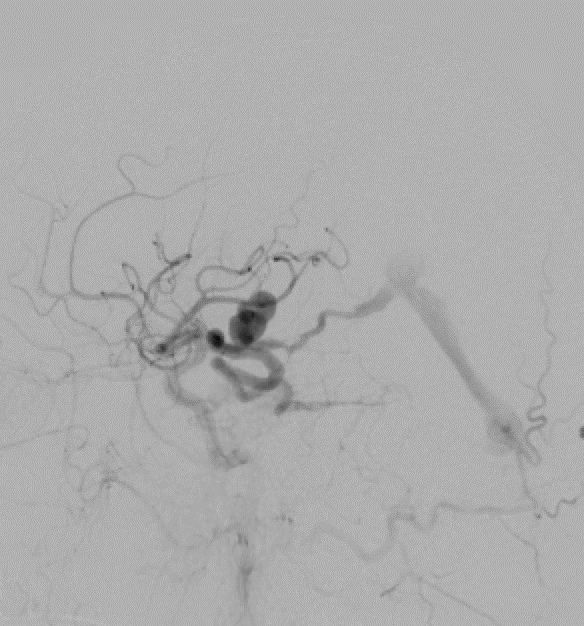 Onyx Transarterial Embolization for Tentorial Dural Arteriovenous